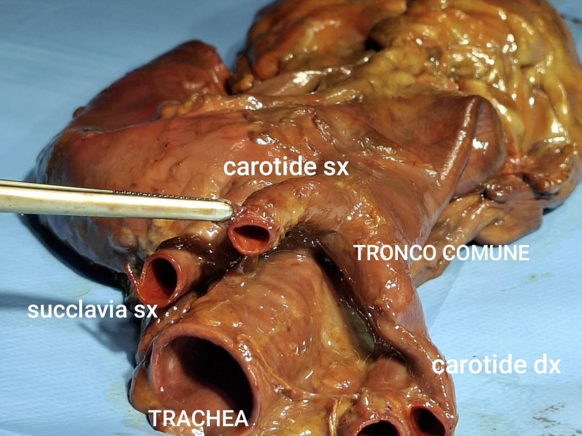 Arco bovino: variante dell’arco aortico tra anatomia, storia e significato&nbsp;clinico