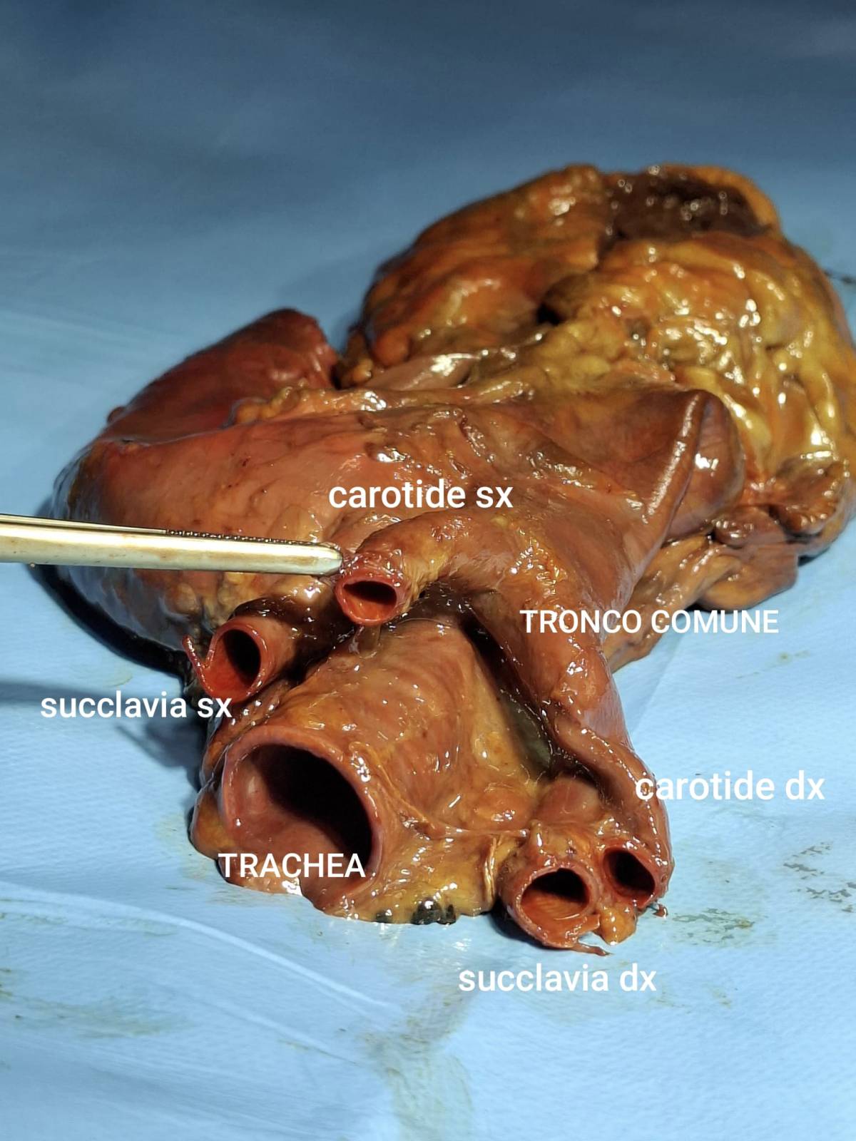 Arco bovino: variante dell’arco aortico tra anatomia, storia e significato&nbsp;clinico