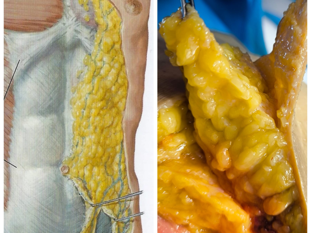 Il giallo del tessuto adiposo: uno dei pochi colori “veri”&nbsp;dell’Anatomia