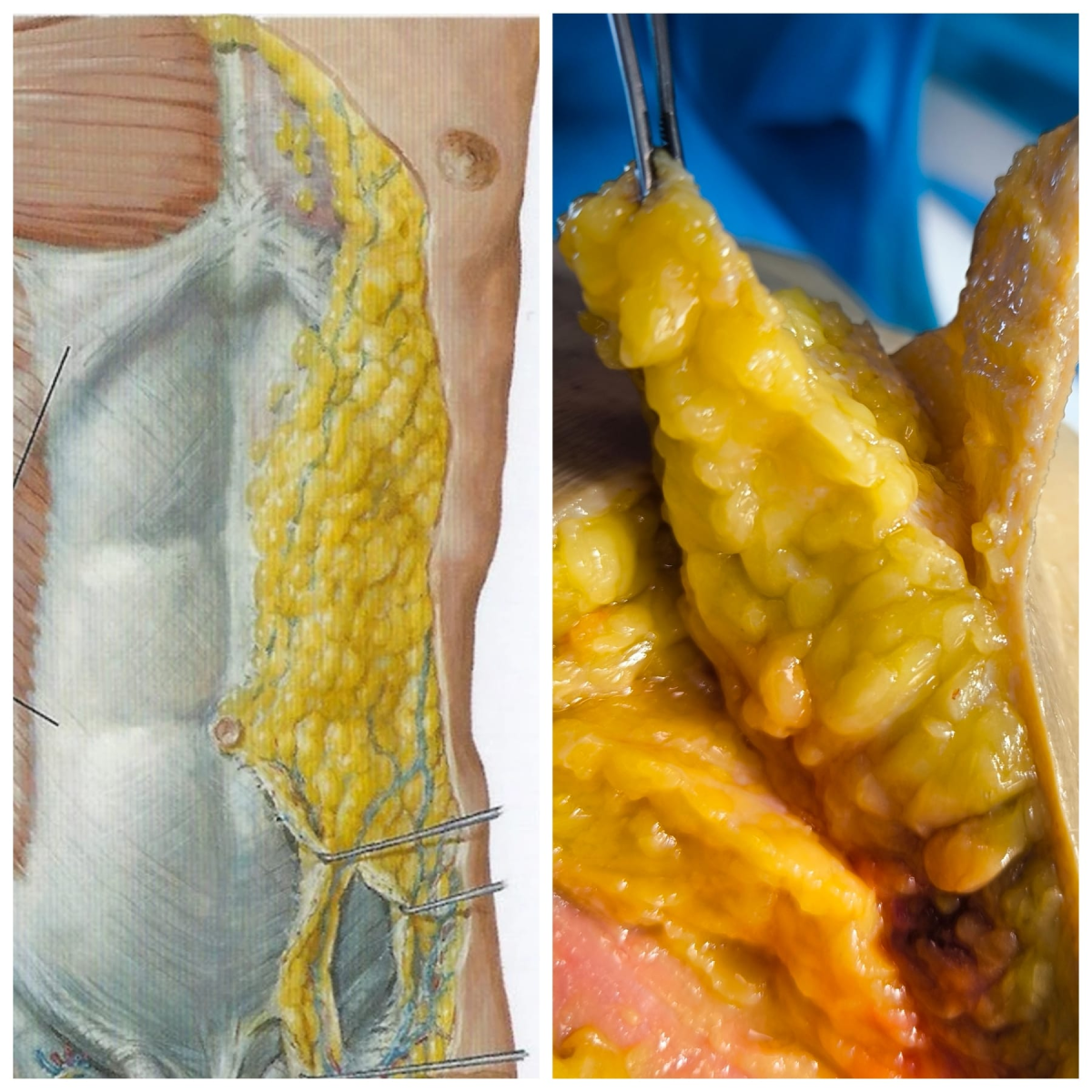 Il giallo del tessuto adiposo: uno dei pochi colori “veri”&nbsp;dell’Anatomia